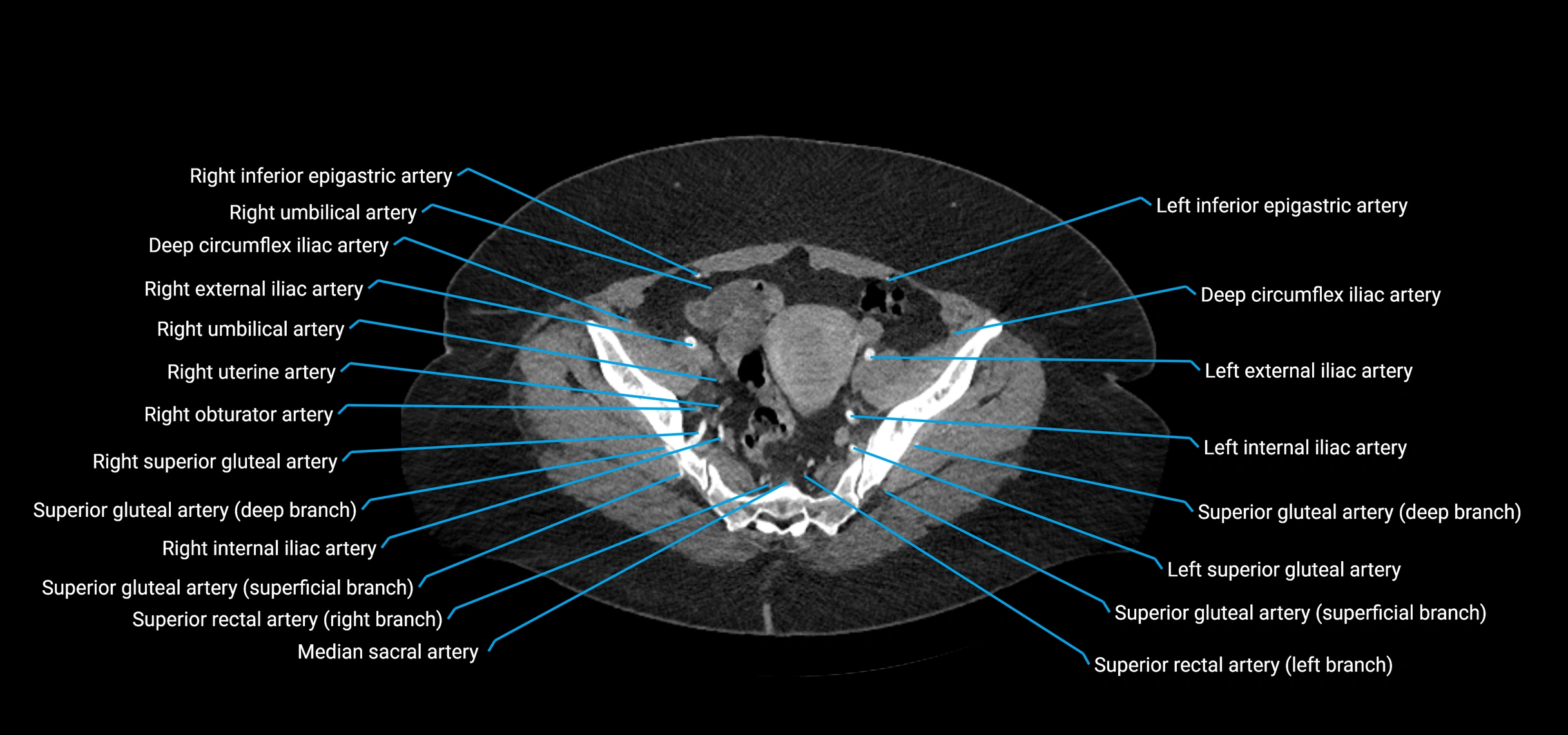 CTA abdomen axial cross sectional anatomy labelled image_210 (2).webp